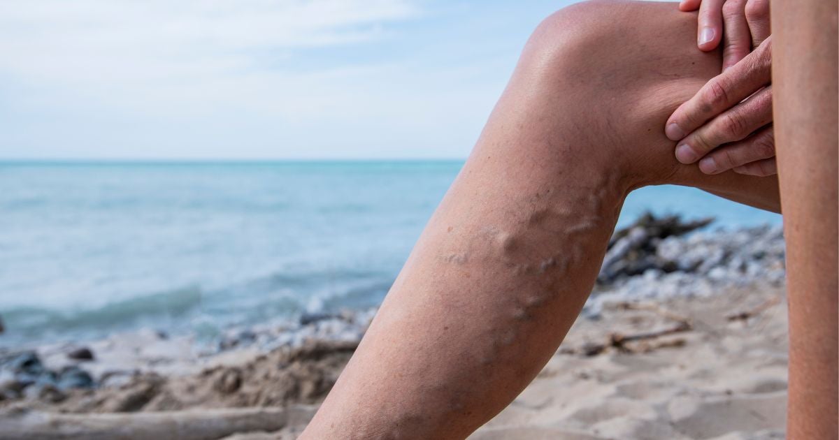 The Power of Topical Cannabis Creams for Varicose Veins: Relieving Symptoms and Enhancing Appearance